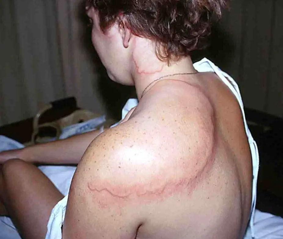 Photo of person with wounds from being stung by box jellyfish.